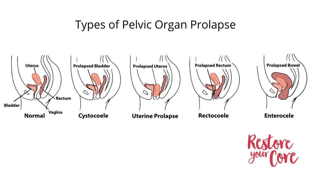 পেলভিক অর্গান প্রল্যাপ্স (pelvic organ prolapse) এর ধরন