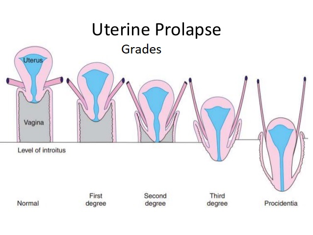 পেলভিক অর্গান প্রল্যাপ্স (pelvic organ prolapse) এর ধাপ বা স্টেজ